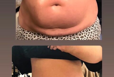 Cupping, Transformational cupping, Buikklachten, Pijnklachten, Bindweefselmassage, Ontspanning, Stress, Spijsvertering, Massage, Traditionele Chinese Geneeskunde, Holistische benadering, Alternatieve geneeskunde, Natuurgeneeskunde, Acupunctuur, Reflexologie, Shiatsu, Triggerpoints, Cupping Barneveld, Ilona Giesbers, Gezondheid, Wellness, Lichaamswerk, Spierklachten, Rugpijn, Nekpijn, Schouderpijn, Hoofdpijn, Migraine, Slaapproblemen, Vermoeidheid, Fibromyalgie, Reumatische aandoeningen, Chronische pijn, Emotionele blokkades, Huidproblemen, Littekenweefsel, Cellulite, Lymfedrainage, Detox, Acne, Rosacea, Eczeem, Psoriasis, Zwangerschapsklachten, Sportblessures, Pre- en postoperatieve behandeling, Ademhalingsoefeningen.